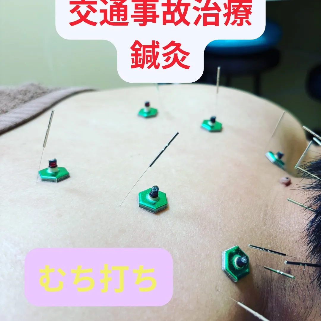 🌿むち打ち症には鍼灸が効果的？🤕✨