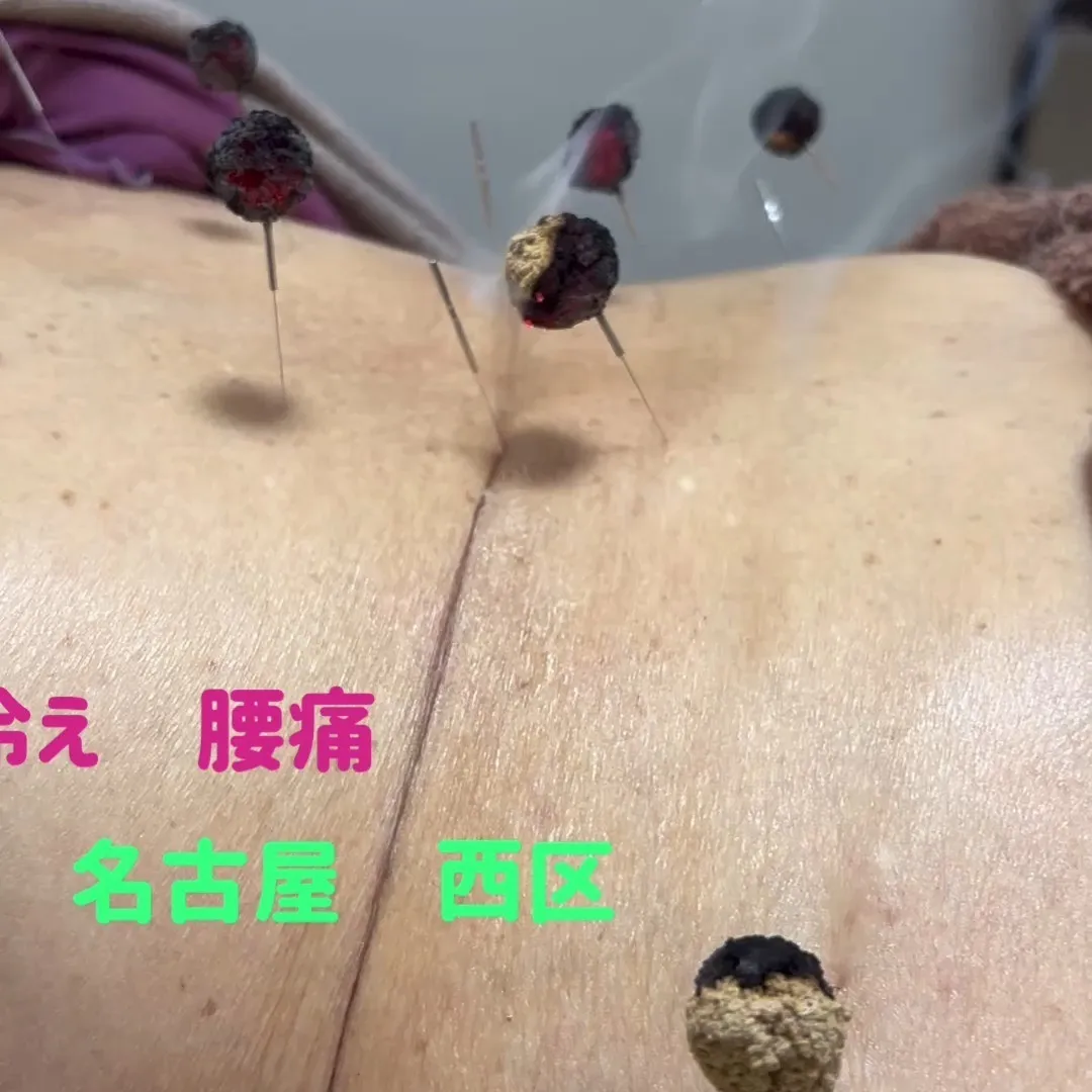 名古屋市西区で効かす鍼を受けられる鍼灸接骨院です！！